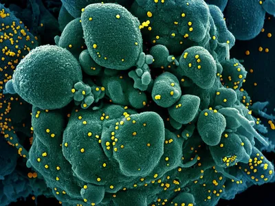 Colorized scanning electron micrograph of a cell (green) infected with SARS-COV-2 virus particles (yellow), isolated from a patient sample.