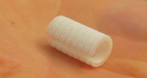 Doctors Use a Dissolvable 3D-Printed Tracheal Splint to Save a