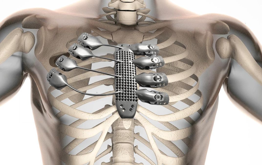 We Can Now 3D Print Ribs