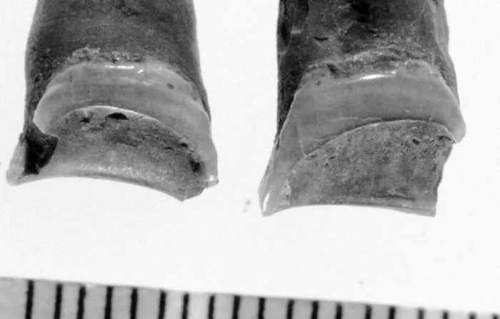 Tooth Wear