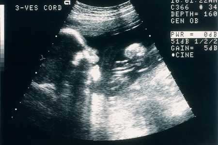 A sonogram of a human fetus.&nbsp;
