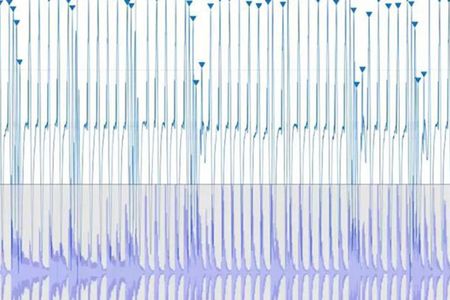 Irregular heart rhythms