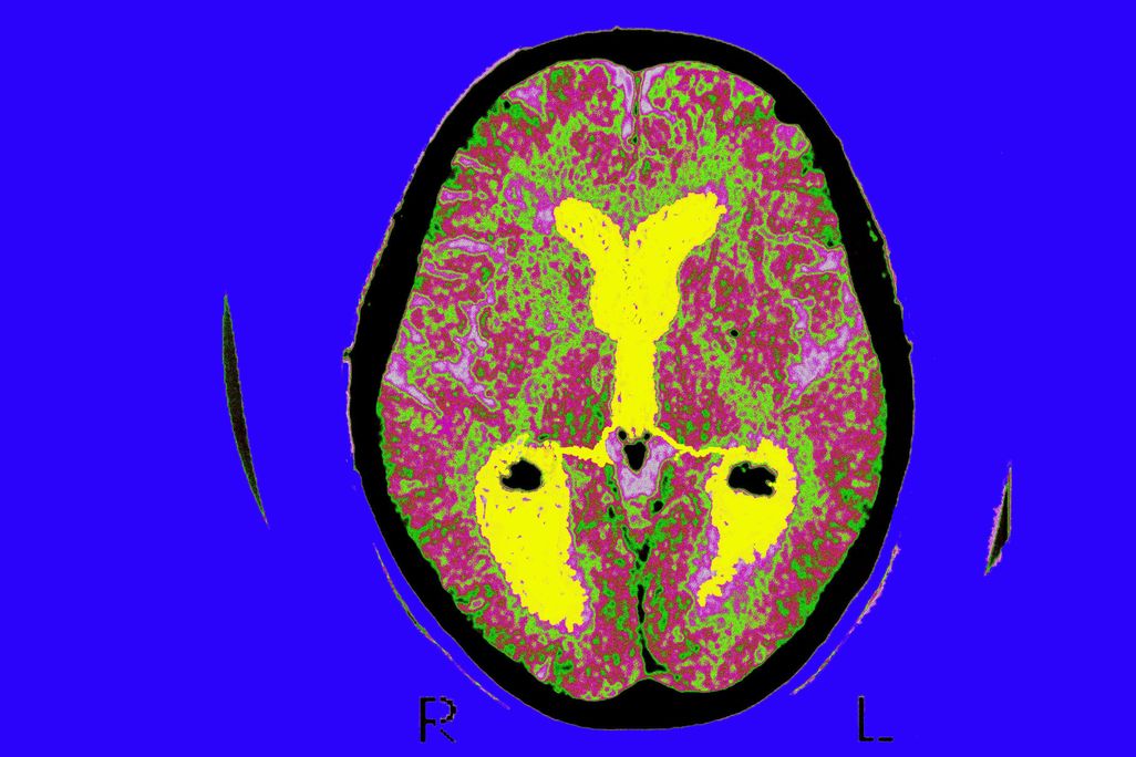 A brain scan of a person with Alzheimer's disease