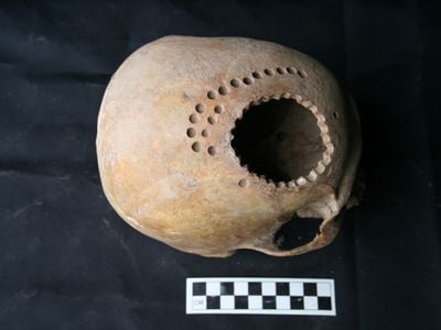 A 900 year-old skull from Peru, whose former owner underwent brain surgery.