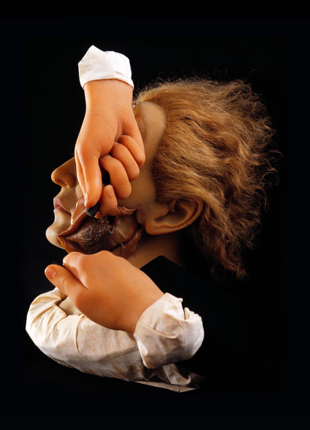 Wax model showing the removal of part of a jaw with "phossy jaw," late 1800s