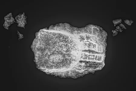 An X-ray shows where the prosthetic metal fingers attach to the device.