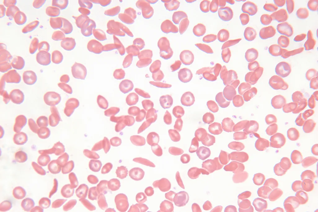 A zoomed in view of both normal, round red blood cells, and crescent-shaped sickle cells