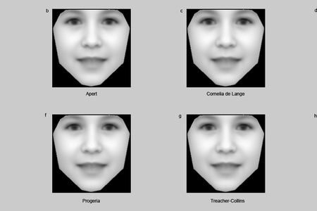 The software can spot people with these disorders: (A) Angelman, (B) Apert, (C) Cornelia de Lange, (D) Down, (E) Fragile X, (F) Progeria, (G) Treacher-Collins, (H) Williams-Beuren.