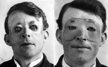 WWI veteran Walter Yeo before (left) and after (right) skin flap surgery performed by Harold Gillies in 1917