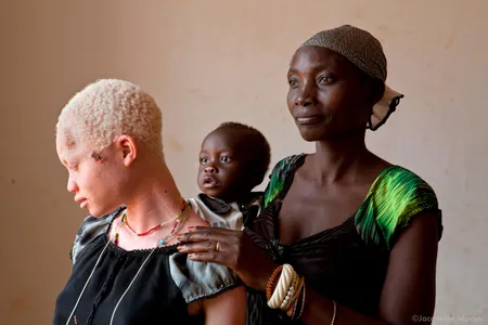 Angel Salvatory, 17, left, poses with her mother Bestida, right, and one-year-old brother Ezekial, at the Kabanga Protectorate Center. People with albinism are in danger from a black market in albino body parts driven by traditional beliefs, black magic and witch doctors. Bestida recounts how Angel’s father had wanted to attack their daughter ever since she was three-months-old. “He thought if we would take Angel to a witch doctor as a sacrifice that we could get rich,” says Bestida. She managed to talk him out of it for years until one day a group of men came armed with machetes. Despite surviving her father’s attack, Angel died of skin cancer in 2013. 
