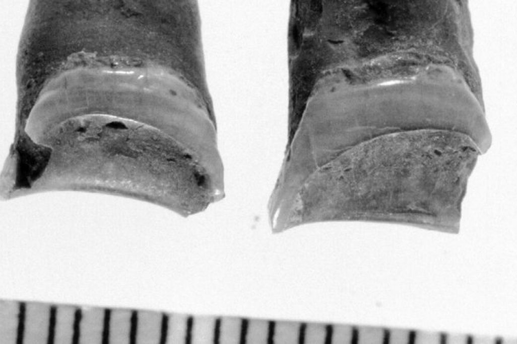 Tooth Wear