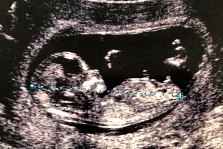 Ultrasound of a 4-month-old fetus