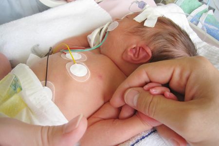  A baby in the neonatal intensive care unit are often covered in patches and wires for monitoring their vital signs, but new advances mean that soon those wires could be replaced with sensors as thin as a temporary tattoo.