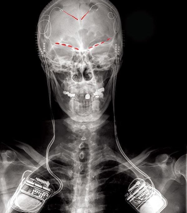 skeleton with red lines above the eyes and near the top of the skull