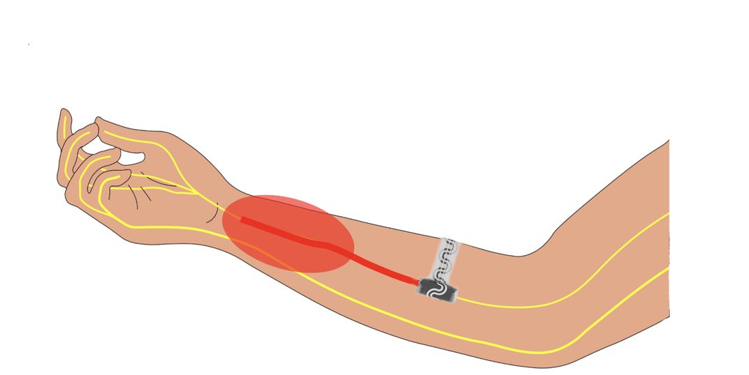 This Dissolvable Implant Could Revolutionize Pain Management