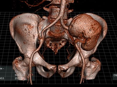 A digital scan of a human kidney and pelvis.