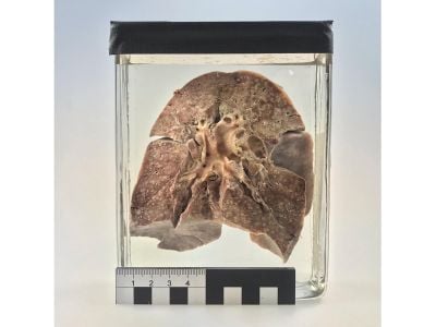 Formalin-fixed lung collected in 1912 in Berlin from a 2-year-old girl who died of measles-related pneumonia