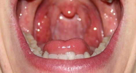 mouth with bacteria in it