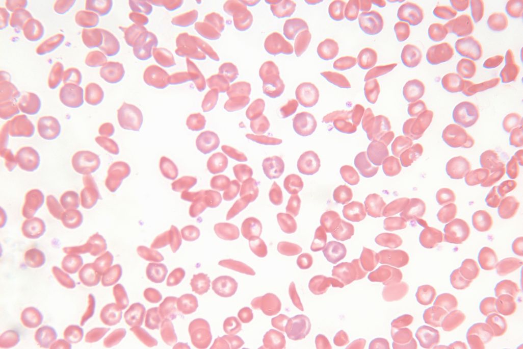 A zoomed in view of both normal, round red blood cells, and crescent-shaped sickle cells