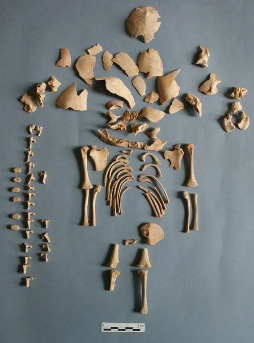 bones and bone fragments from a skeleton of an infant with down syndrome laid on a table to resemble a skeleton