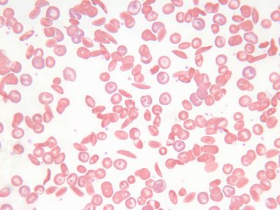 A blood smear of a patient with sickle cell. The crescent-shaped sickle cells can be seen in the smear.