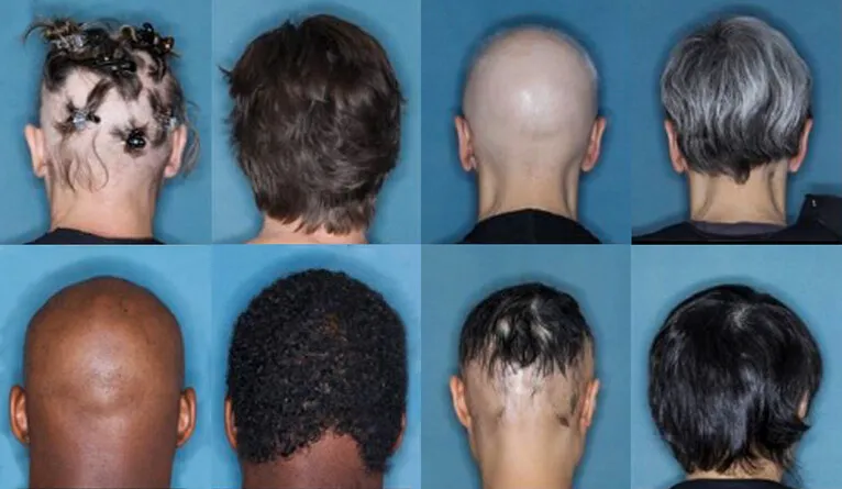 An image of four alopecia patients showing their before and after hair growth after taking the drug baricitinib.