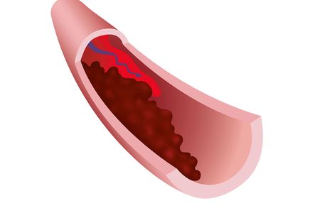 The formation of a blood clot