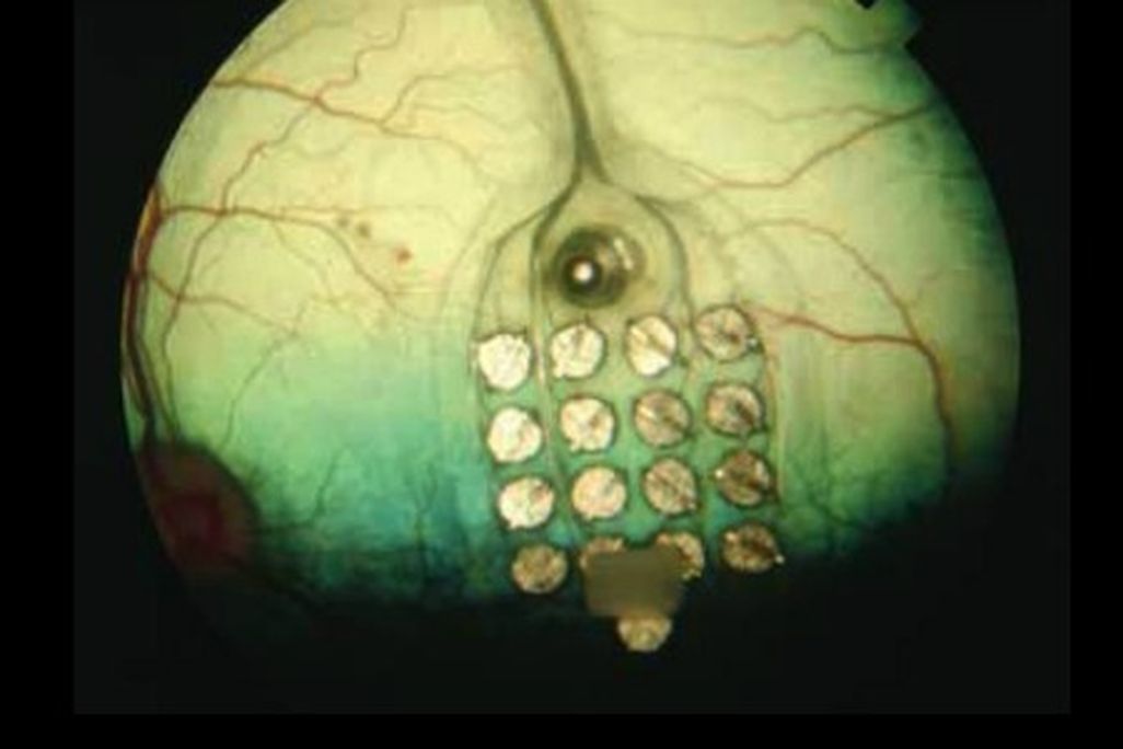 The system uses a grid of surgically implanted electrodes to enable a blind person to “see” the letters.