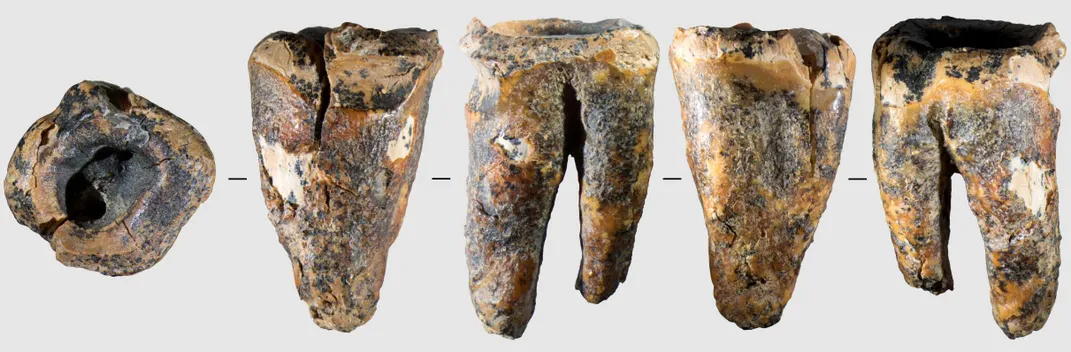 A Neanderthal molar with a hole in it shown from different angles