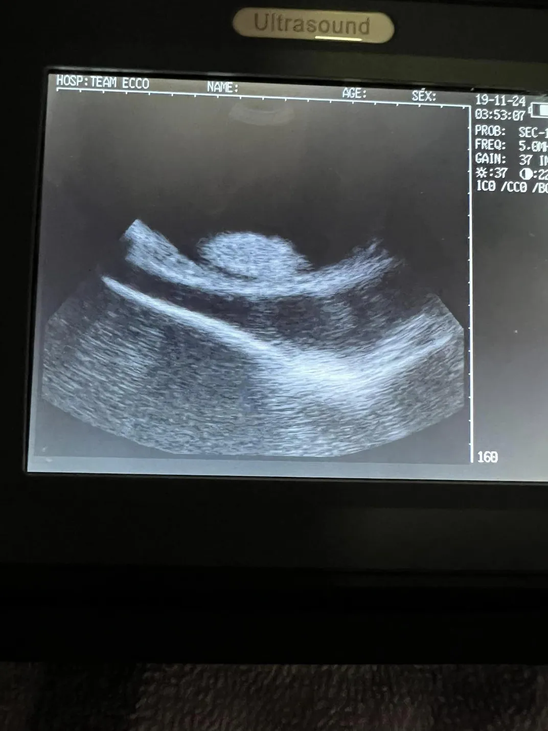 an ultrasound on a screen