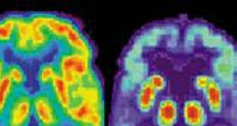 The brain scan on right shows Alzheimer’s damage.