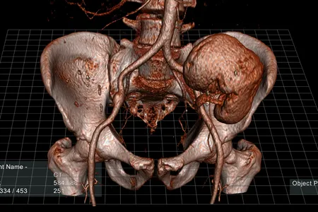 A digital scan of a human kidney and pelvis.