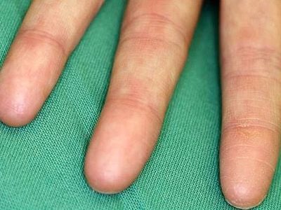 The finger pads of a person with adermatoglyphia are entirely smooth.
