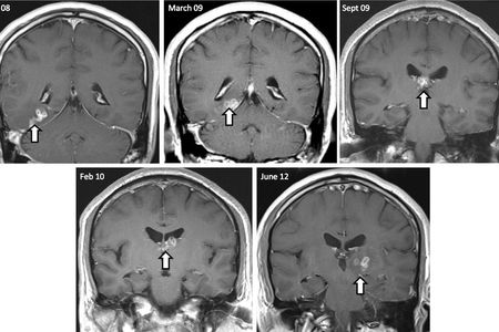 The worm's progression through the man's brain, over a four year period. 