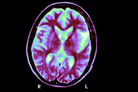 An MRI of a brain of a person with Alzheimer&#39;s disease. A new study suggests having two copies of a genetic variant called APOE4 is a cause of the disease, not just a risk factor for it.