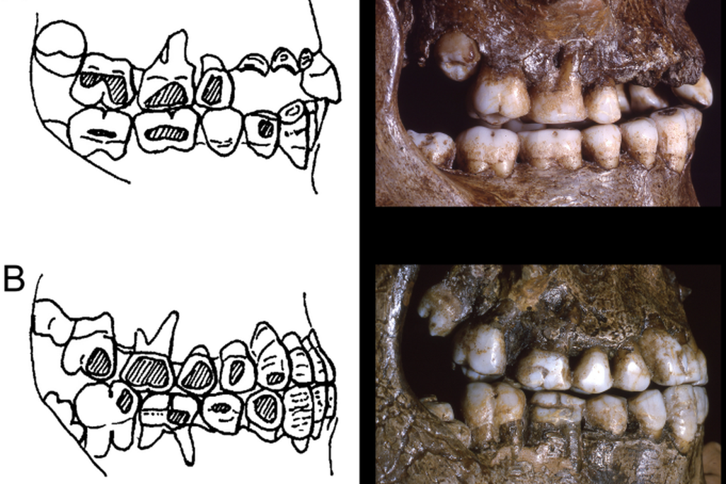 Graphic that shows wear patterns on teeth