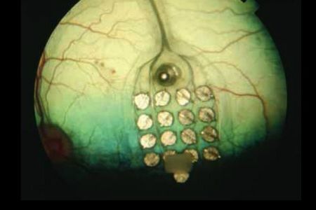 The system uses a grid of surgically implanted electrodes to enable a blind person to “see” the letters.