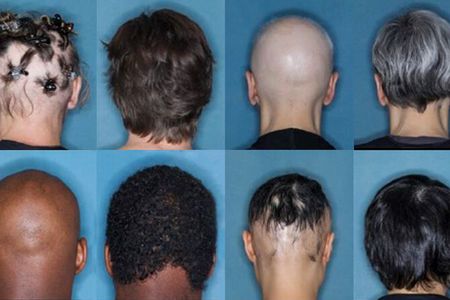Before and after images of four study participants who recieved 36 weeks of treatment for severe alopecia areata with the drug baricitinib.