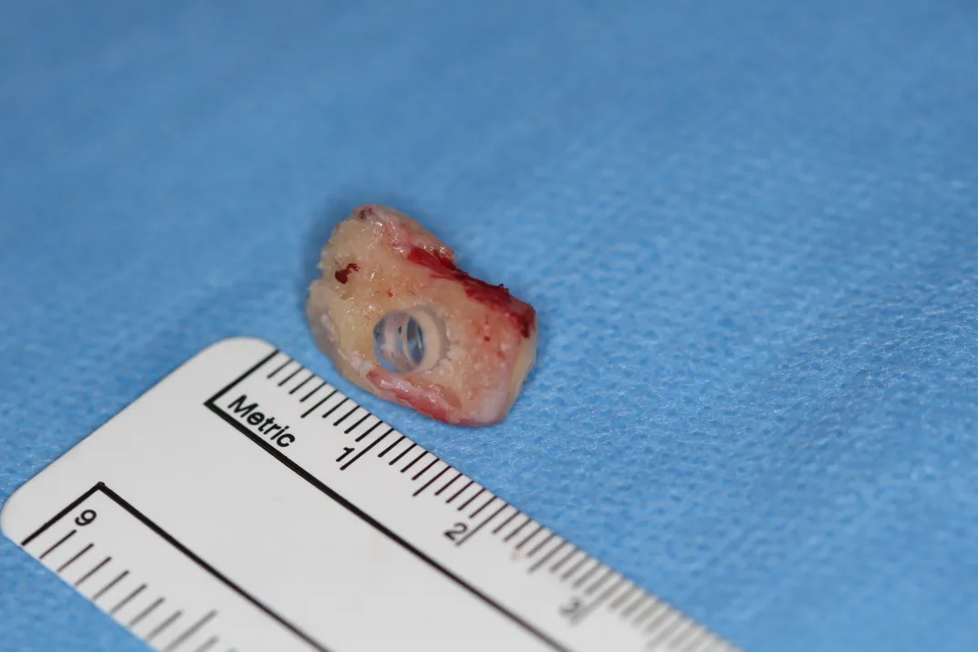 Small tooth with plastic lens next to measuring tape