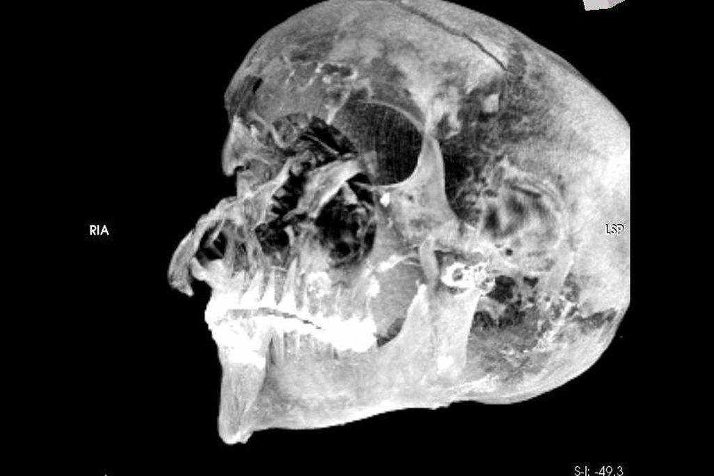 X-ray image of mummy's head