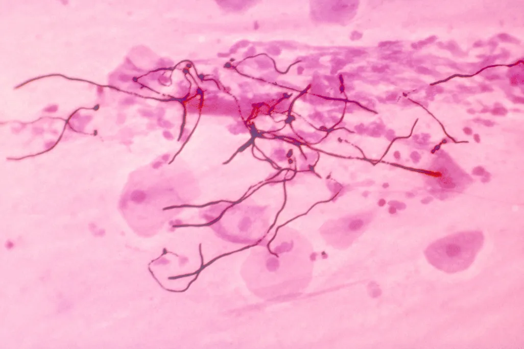 A stained micrograph revealing the presence of the fungus Candida albicans.
