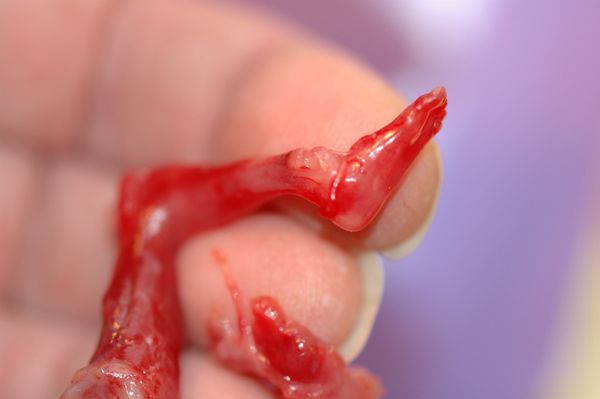 "Leg in Hand" 
aborted baby, 14 weeks. thumbnail