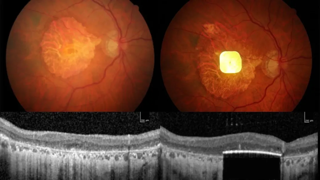 a retina without an implant (left) and with the implant (right)