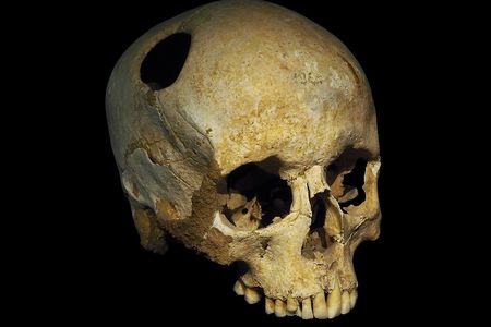 The trepanated skull of a Neolithic woman. The fact that the hole is rounded off by ingrowth of new bone suggests that the patient survived the operation.