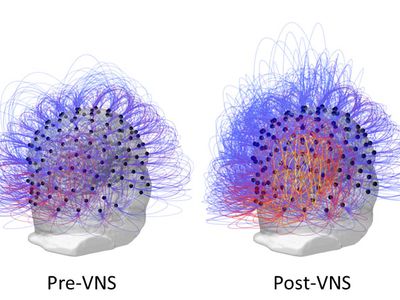 A comparison of the man's brain activity before and after he had vagus nerve stimulation.