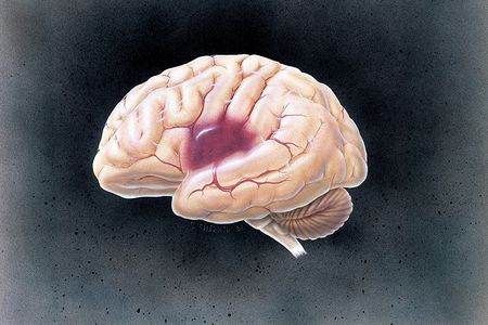 Researchers at Chalmers University of Technology in Sweden think that a helmet called the Strokefinder could quickly diagnose intracranial bleeding.