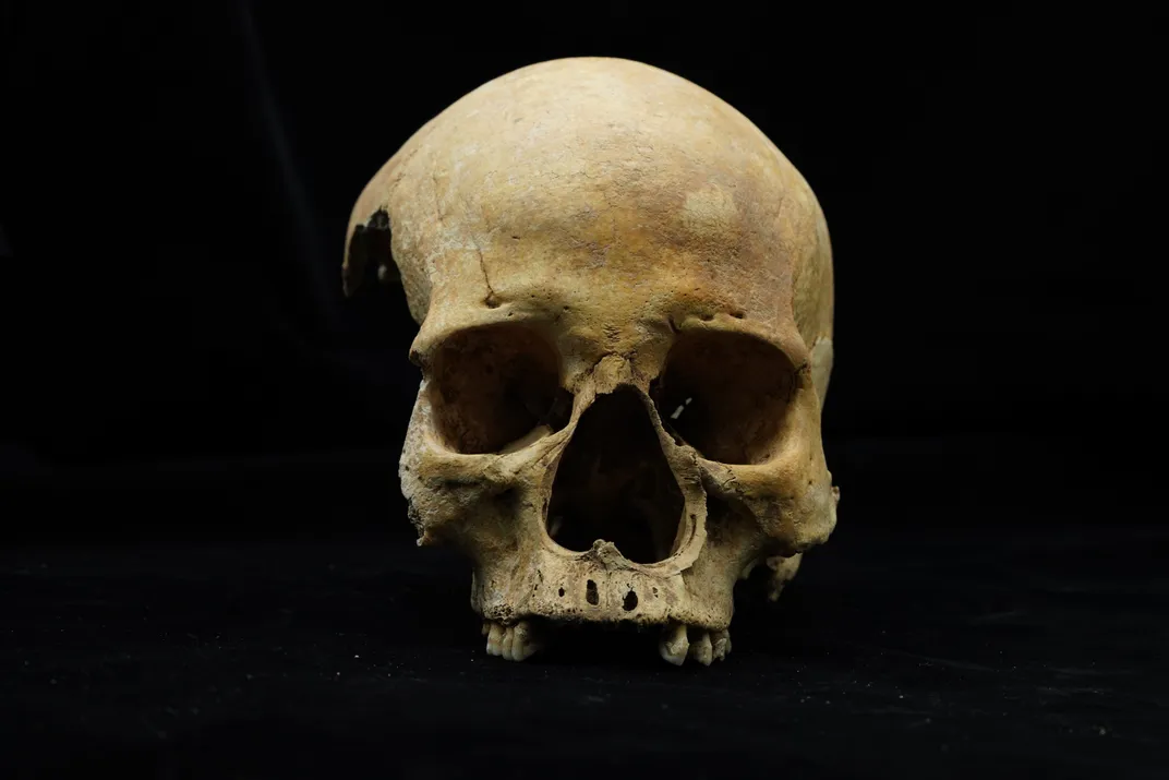 A frontal view of a human skull with a large nasal cavity