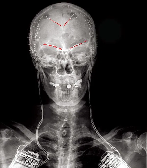 skeleton with red lines above the eyes and near the top of the skull