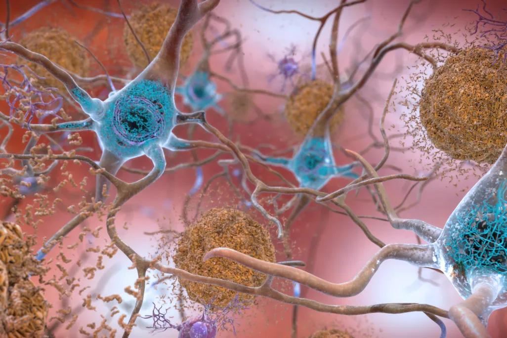 amyloid and tau in the brain