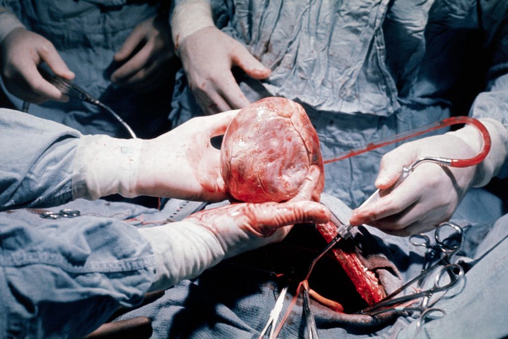 heart transplant